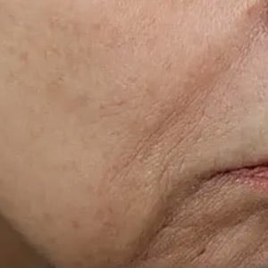 Bucktown DOT FOR WRINKLES ON FACE 18 MONTHS AFTER 1ST TREATMENT