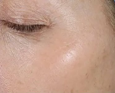 Bucktown MICROPEN PRP DERMAPEEL AFTER 3 TREATMENTS ALTERNATING