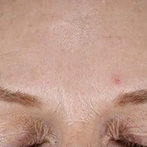 Bucktown MICROPEN PRP DERMAPEEL AFTER THREE TREATMENTS ALTERNATING 2