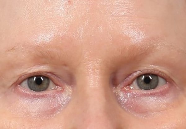 Bucktown SylFirm After 3 treatments to forehead and eyelids