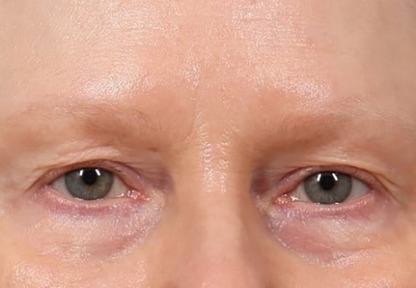 Bucktown SylFirm Before 3 treatments to forehead and eyelids