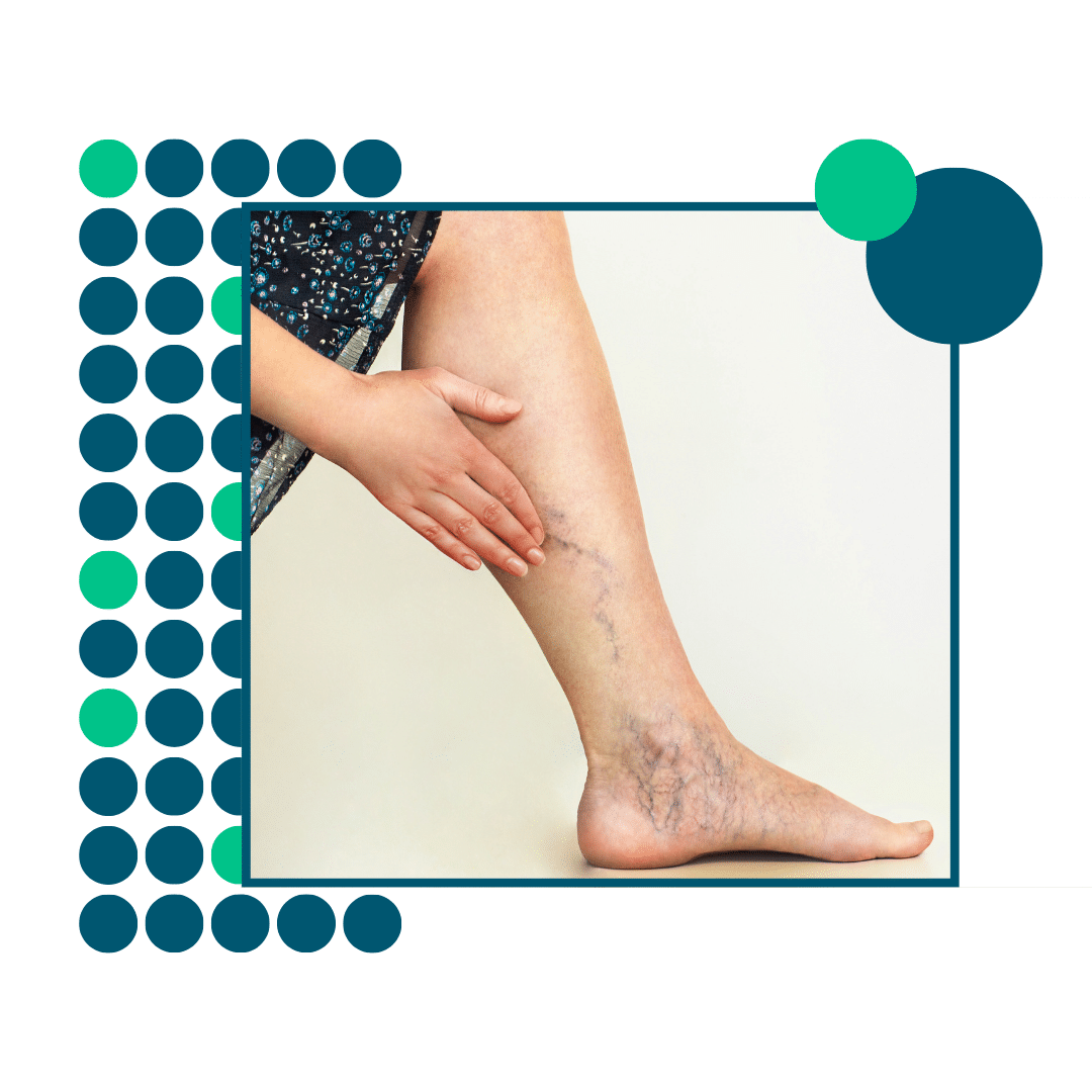 Sclerotherapy feature (1)