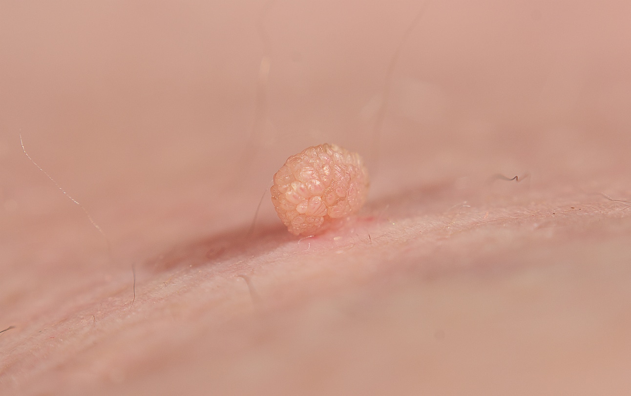 Close up shot of a small skin tag.