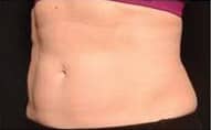 pinski CoolSculpting FemaleAbdomen 2 after 16 weeks after second coolsculpting session