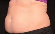 pinski CoolSculpting FemaleAbdomen 2 before