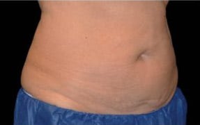 pinski CoolSculpting FemaleAbdomen after 8 weeks after second coolsculpting session