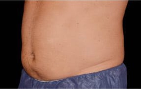 pinski CoolSculpting MaleAbdomen 2 after 6 months after coolsculpting session