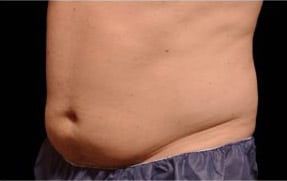 pinski CoolSculpting MaleAbdomen 2 before