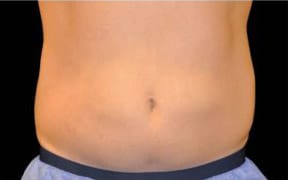 pinski CoolSculpting MaleAbdomen after 14 weeks after coolsculpting session