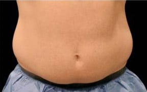 pinski CoolSculpting MaleAbdomen before