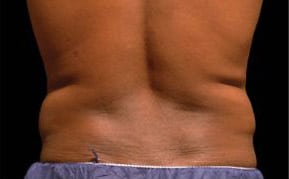 pinski CoolSculpting MaleFlanks before