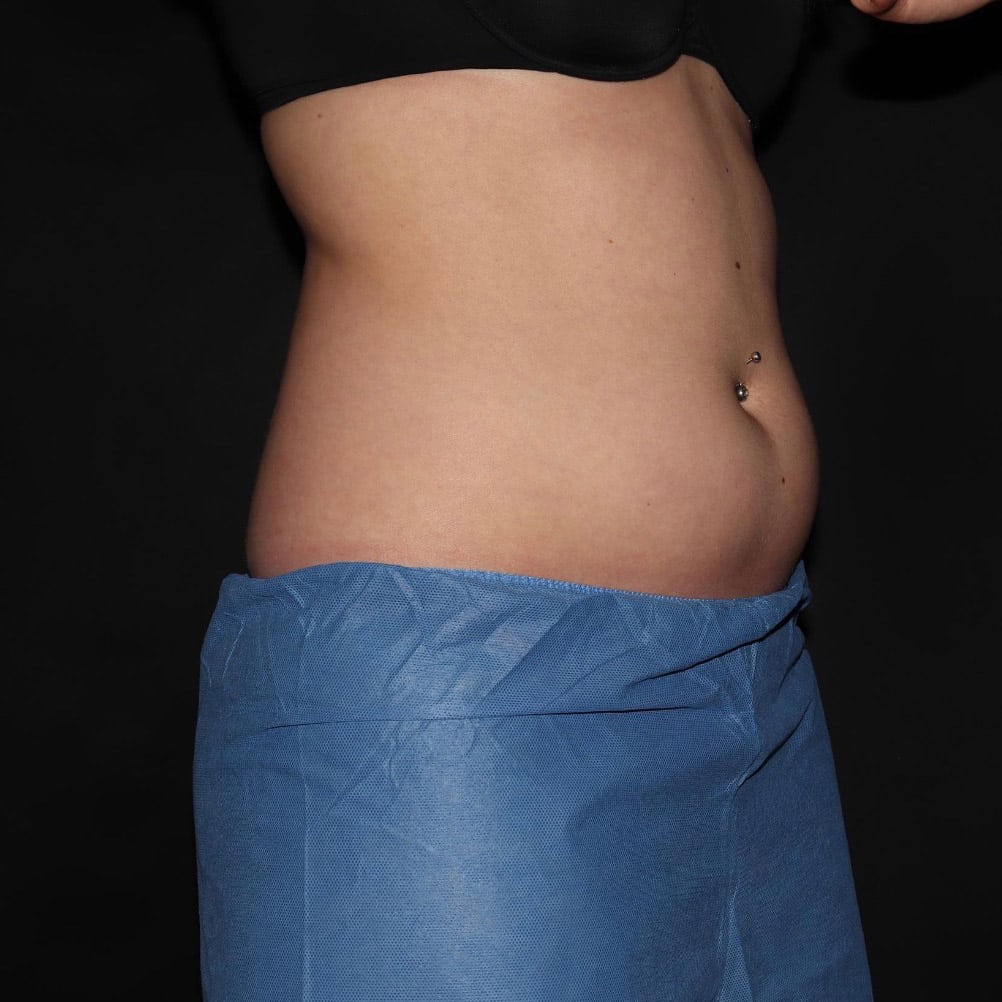 pinski coolsculpting 2 before