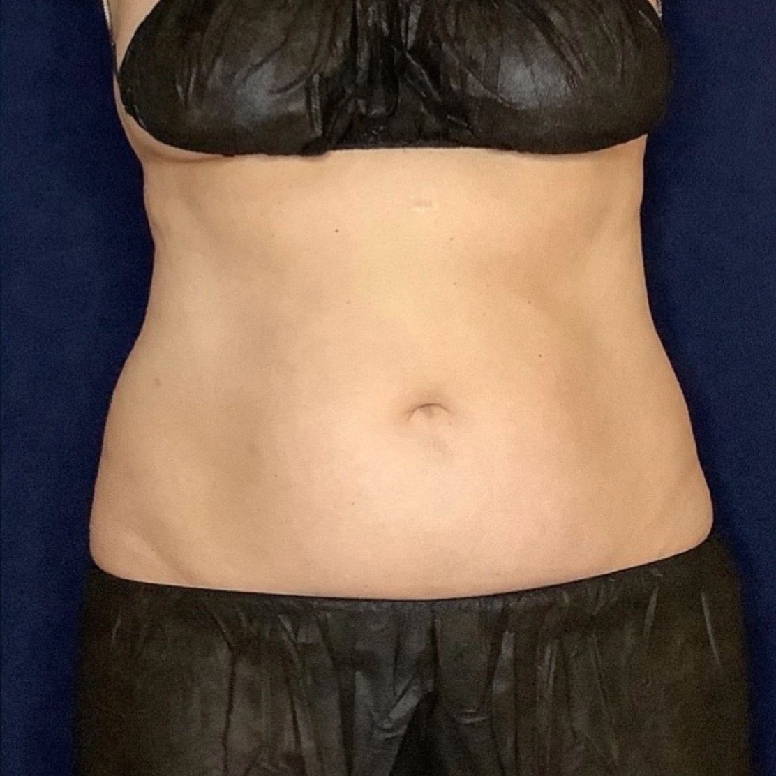 pinski coolsculpting 4 after