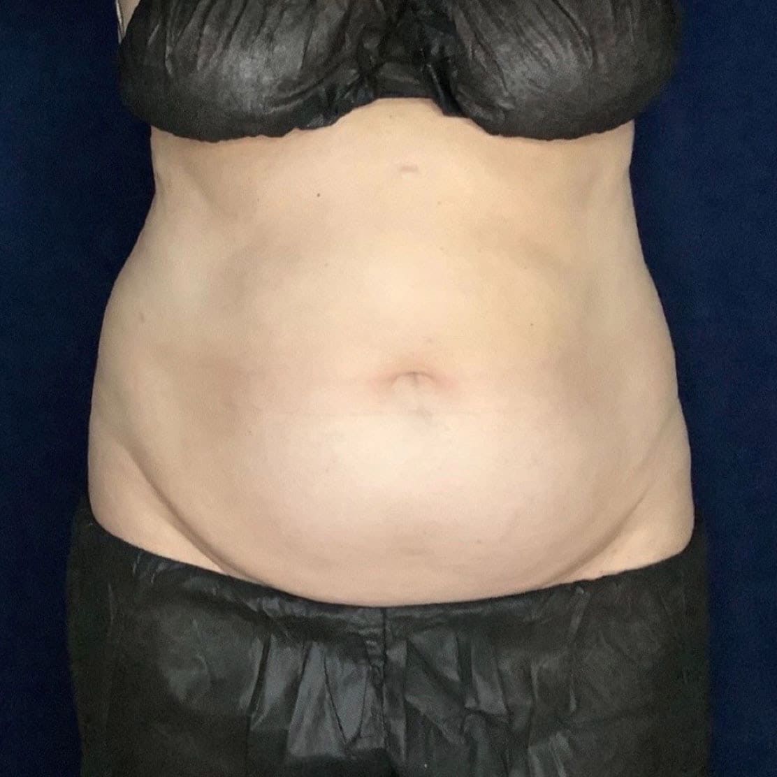 pinski coolsculpting 4 before