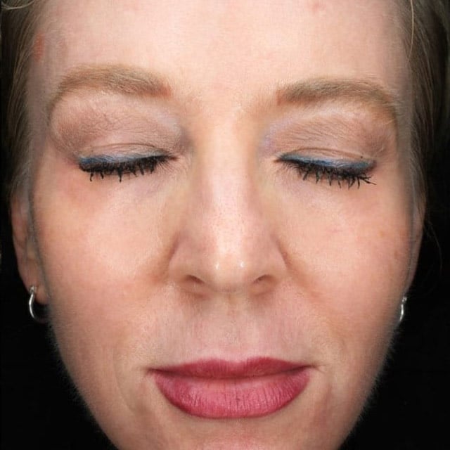 pinski facial rejuvenation 1 after