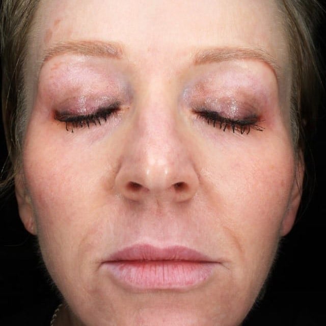 pinski facial rejuvenation 1 before