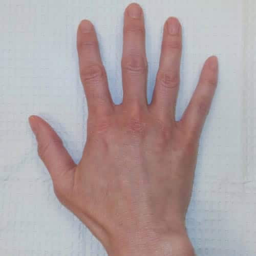 pinski hand rejuvenation radiesse 2 after