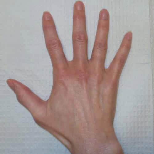 pinski hand rejuvenation radiesse 2 before