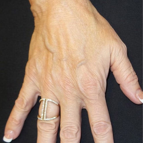 pinski hand rejuvenation radiesse 3 before