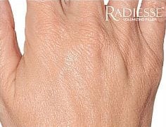 pinski hand rejuvenation radiesse 4 after