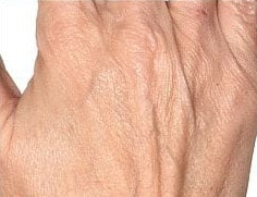 pinski hand rejuvenation radiesse 4 before