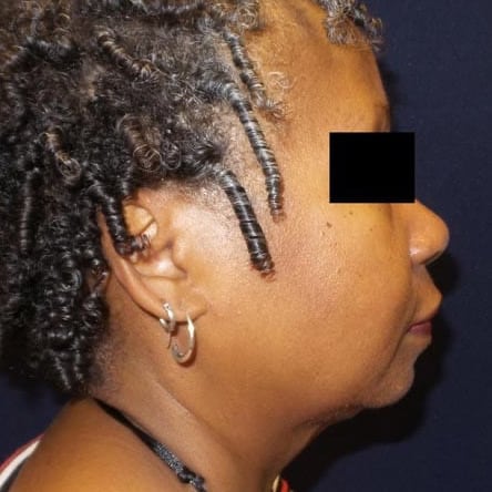 pinski kybella 7 after