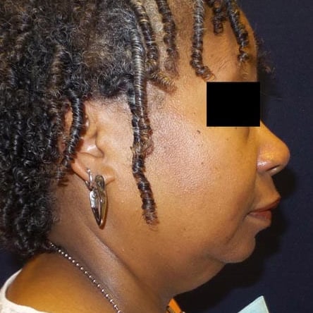 pinski kybella 7 before