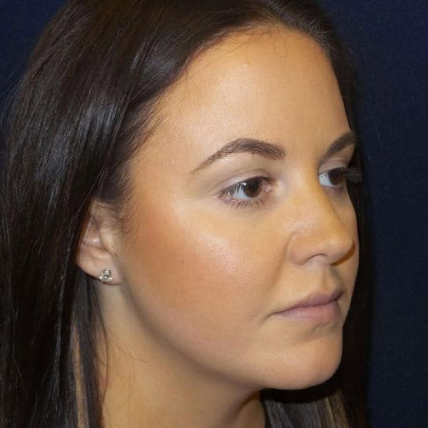 pinski kybella 8 after
