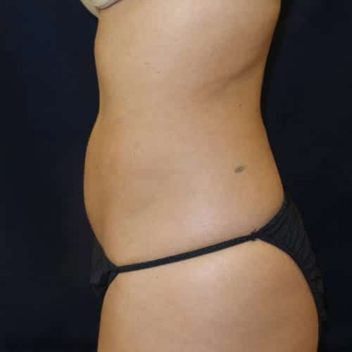 pinski liposculpting 1 after