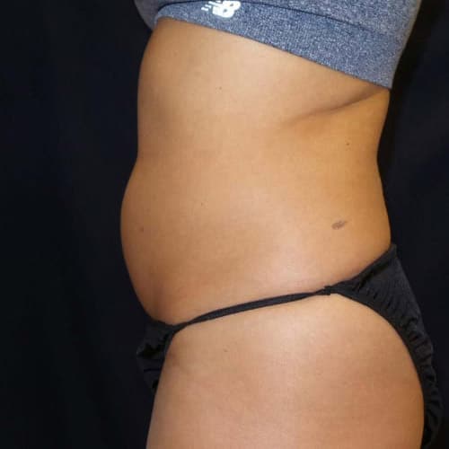 pinski liposculpting 1 before