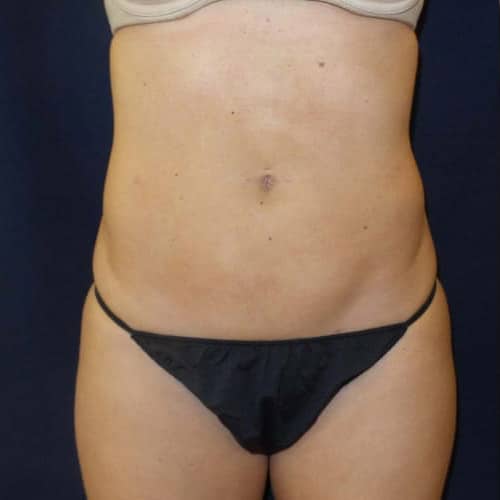 pinski liposculpting 2 after