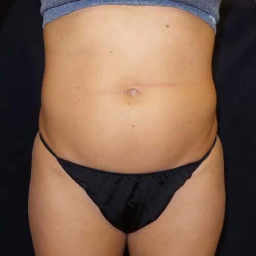 pinski liposculpting 2 before