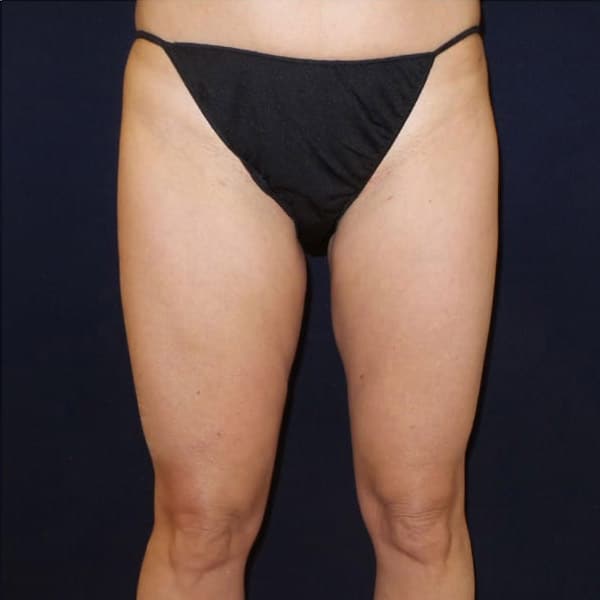 pinski liposculpting 3 after