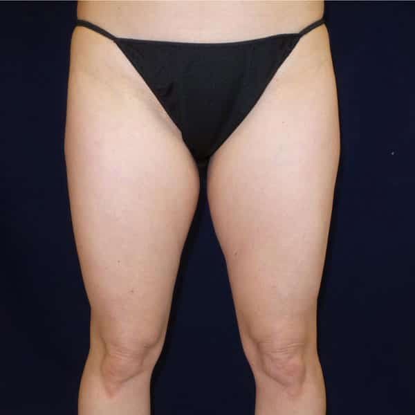 pinski liposculpting 3 before