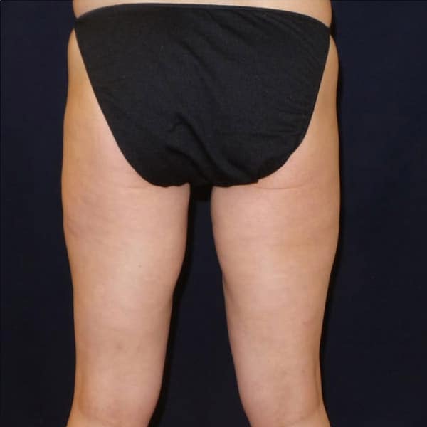 pinski liposculpting 4 after