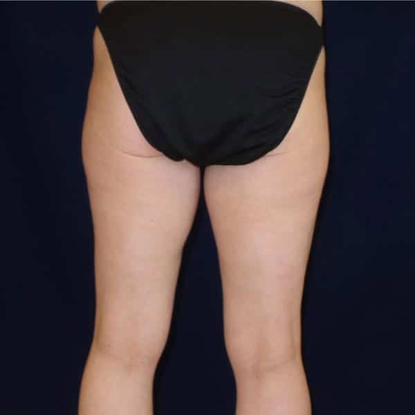 pinski liposculpting 4 before