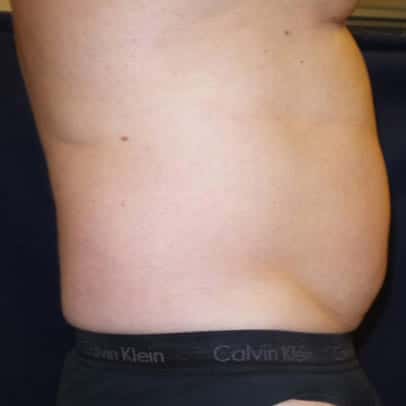 pinski liposculpting 5 before