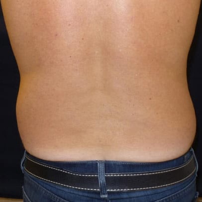 pinski liposculpting 6 after