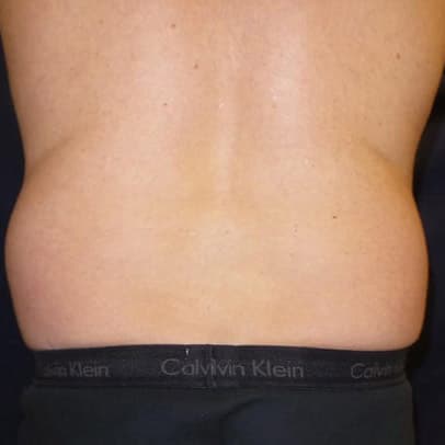 pinski liposculpting 6 before