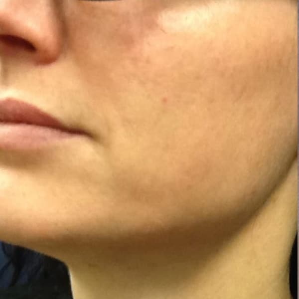 pinski ultherapy 2 after