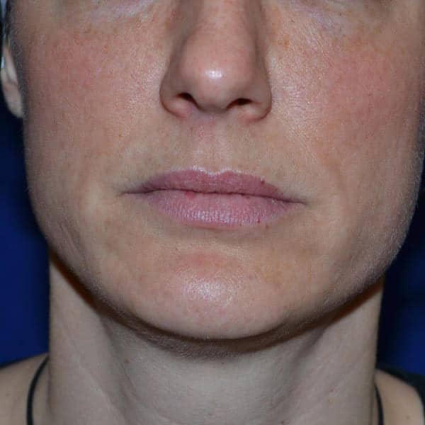 pinski ultherapy 3 before