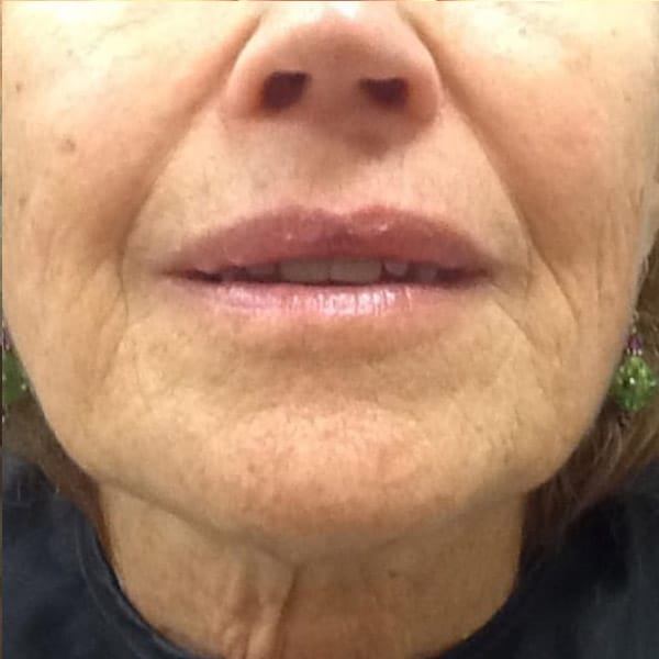 pinski ultherapy 4 after