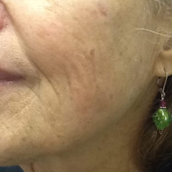 pinski ultherapy 5 after