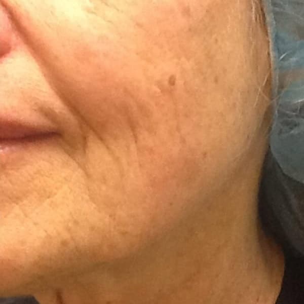 pinski ultherapy 5 before