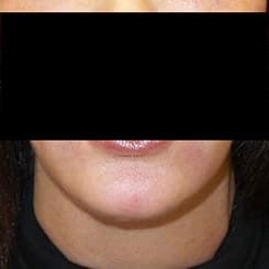 pinski ultherapy and kybella 1 after