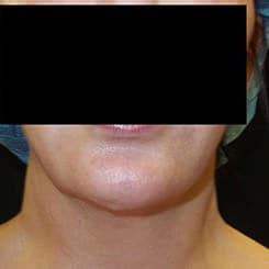 pinski ultherapy and kybella 1 before