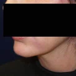 pinski ultherapy and kybella 2 after
