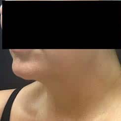 pinski ultherapy and kybella 2 before