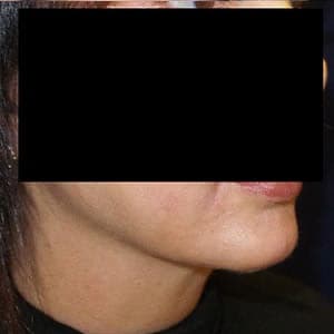 pinski ultherapy and kybella 3 after