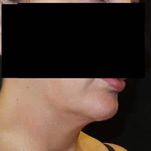 pinski ultherapy and kybella 3 before